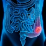 kolon-kanseri-belirti-vermeden-ilerleyebilir-erken-teshisle-sagliginizi-koruyun.jpg